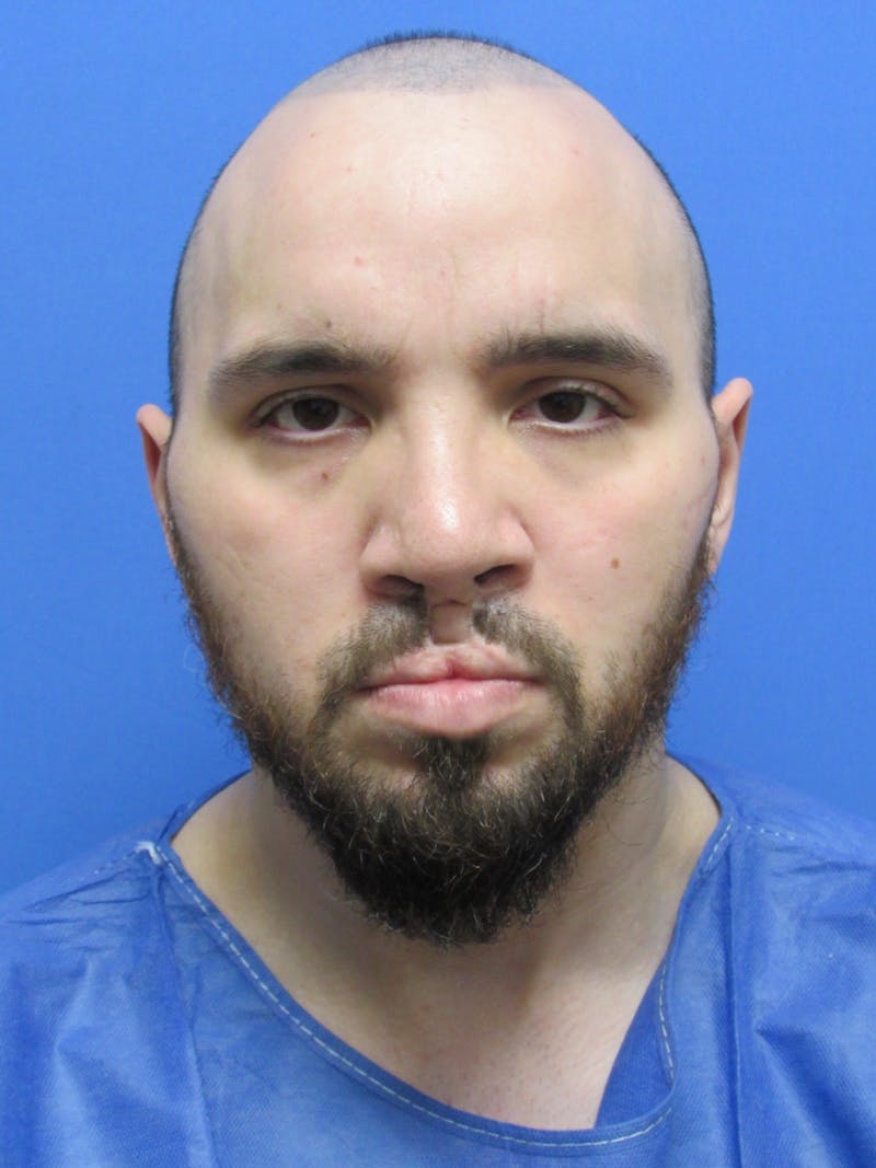 Facial Hair Transplant Before & After Gallery - Patient 188959 - Image 3