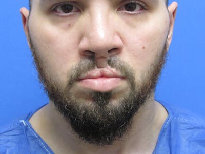 Facial Hair Transplant Before & After Gallery - Patient 188959 - Image 1