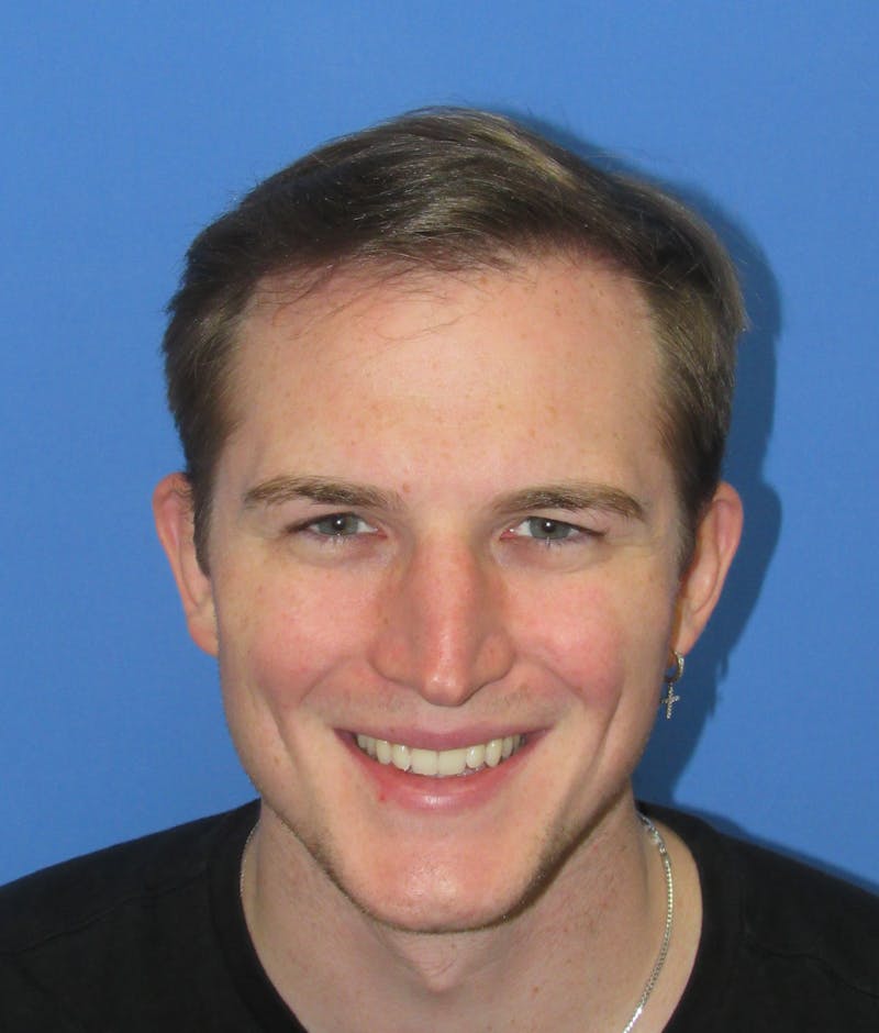 Male Hair Transplant Before & After Gallery - Patient 240847 - Image 2