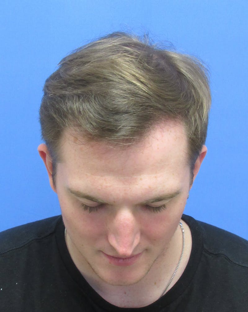 Male Hair Transplant Before & After Gallery - Patient 240847 - Image 4
