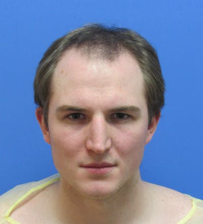 Male Hair Transplant Before & After Gallery - Patient 240847 - Image 1