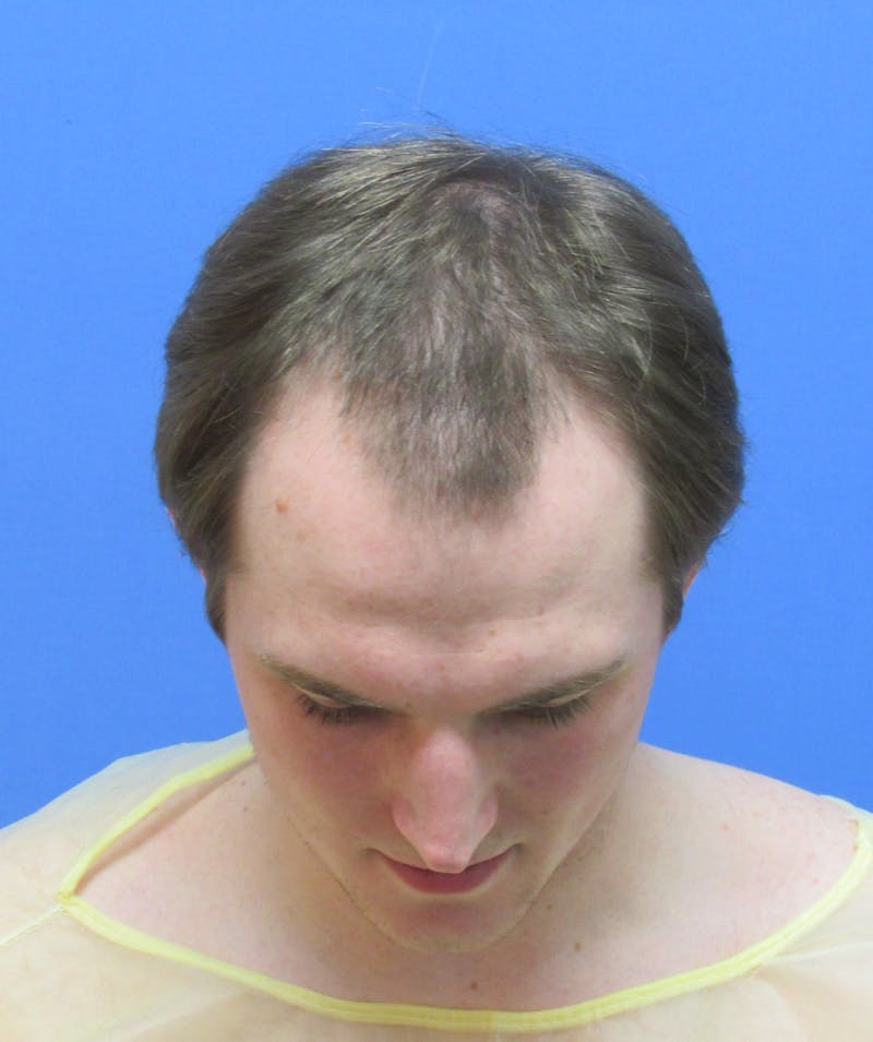 Male Hair Transplant Before & After Gallery - Patient 240847 - Image 3