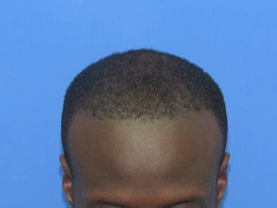 Male Hair Transplant Before & After Gallery - Patient 116946 - Image 2