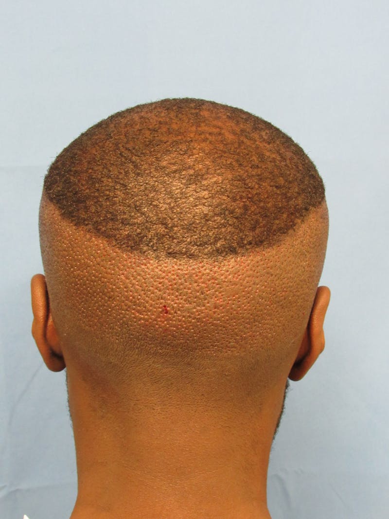 Male Hair Transplant Before & After Gallery - Patient 116946 - Image 4