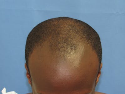 Male Hair Transplant Before & After Gallery - Patient 116946 - Image 1