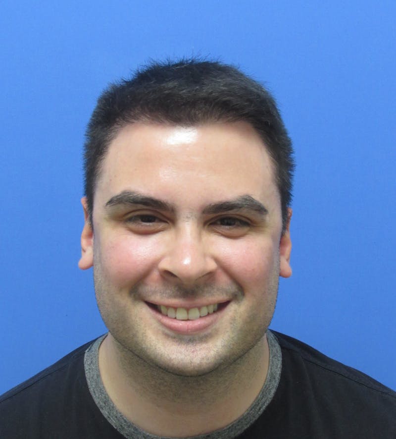 Male Hair Transplant Before & After Gallery - Patient 127331 - Image 4