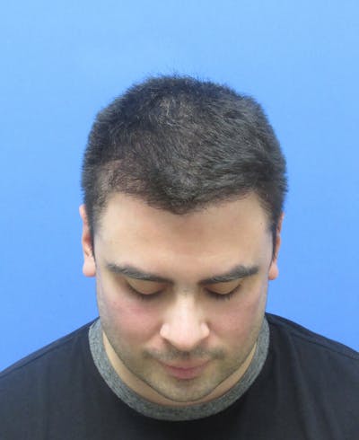 Male Hair Transplant Before & After Gallery - Patient 127331 - Image 2