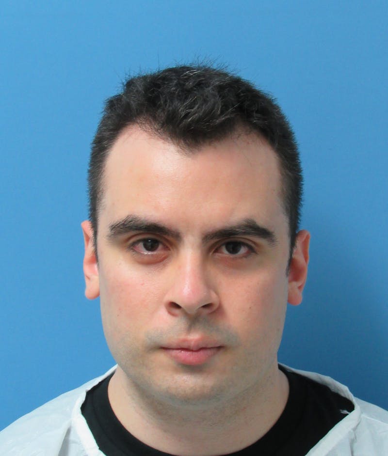 Male Hair Transplant Before & After Gallery - Patient 127331 - Image 3