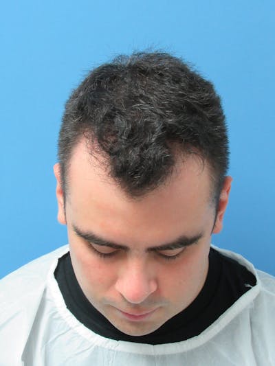 Male Hair Transplant Before & After Gallery - Patient 127331 - Image 1