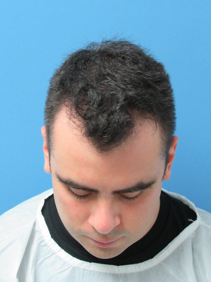 Male Hair Transplant Before & After Gallery - Patient 127331 - Image 1