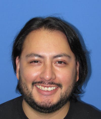 Male Hair Transplant Before & After Gallery - Patient 179524 - Image 2