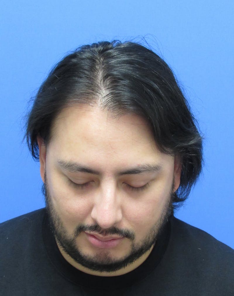 Male Hair Transplant Before & After Gallery - Patient 179524 - Image 4