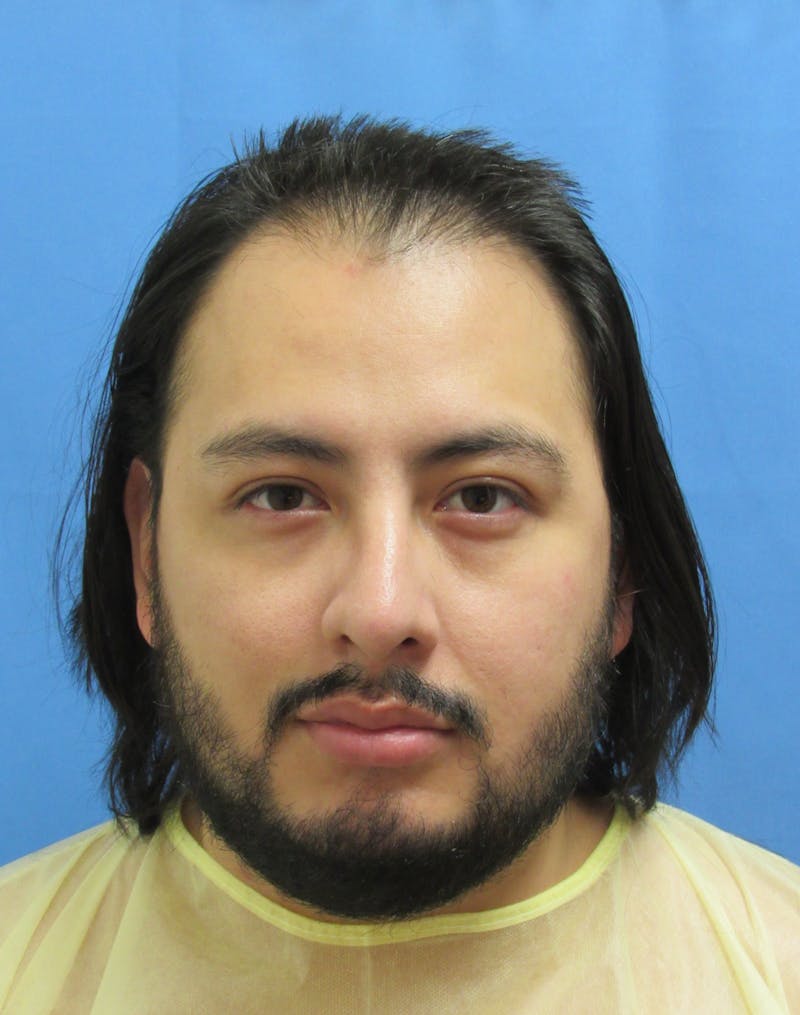 Male Hair Transplant Before & After Gallery - Patient 179524 - Image 1