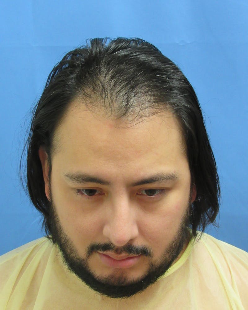Male Hair Transplant Before & After Gallery - Patient 179524 - Image 3