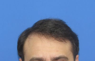 Male Hair Transplant Before & After Gallery - Patient 250881 - Image 2