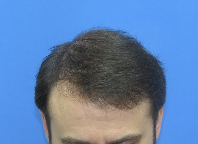 Male Hair Transplant Before & After Gallery - Patient 250881 - Image 4