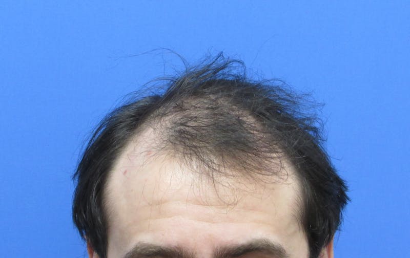 Male Hair Transplant Before & After Gallery - Patient 250881 - Image 1