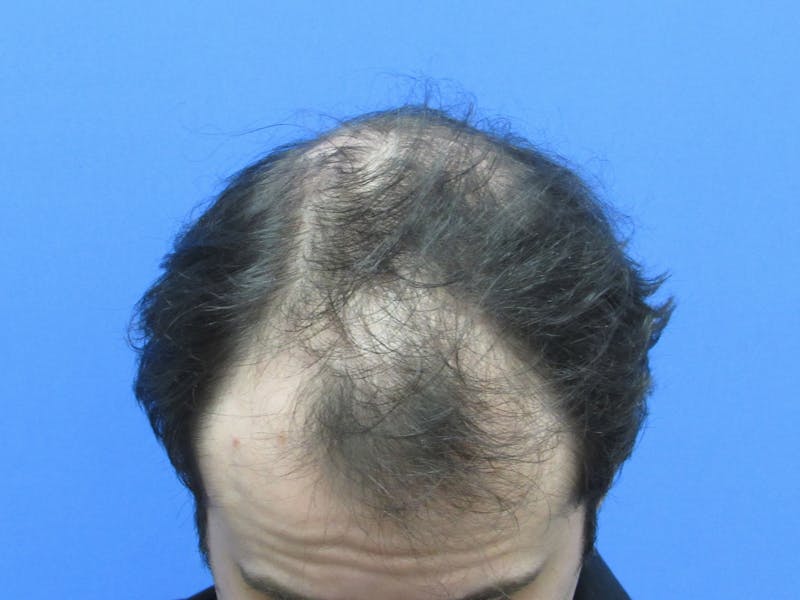 Male Hair Transplant Before & After Gallery - Patient 250881 - Image 3