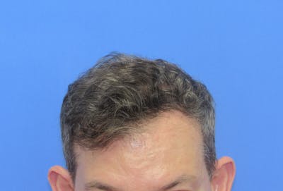 Male Hair Transplant Before & After Gallery - Patient 141499 - Image 2