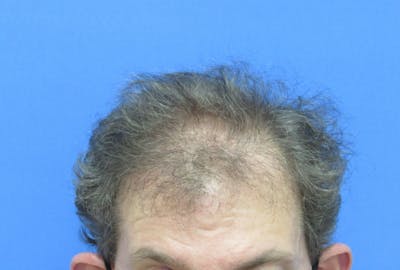 Male Hair Transplant Before & After Gallery - Patient 141499 - Image 1