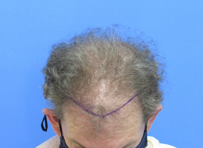 Male Hair Transplant Before & After Gallery - Patient 141499 - Image 3