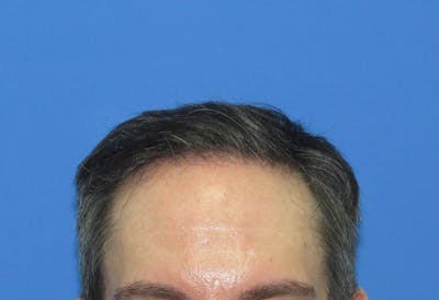Male Hair Transplant Before & After Gallery - Patient 302922 - Image 2