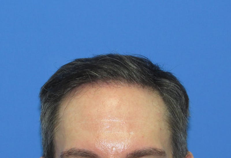 Male Hair Transplant Before & After Gallery - Patient 302922 - Image 2