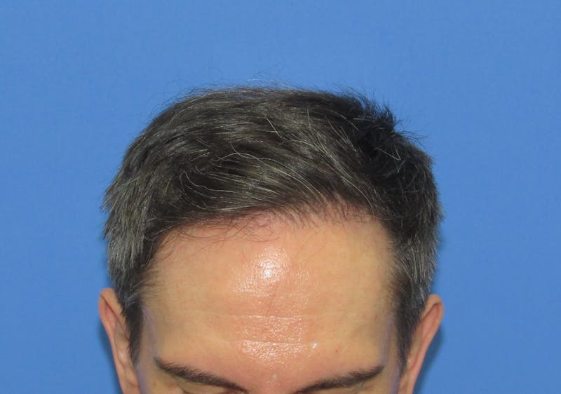Male Hair Transplant Before & After Gallery - Patient 302922 - Image 4