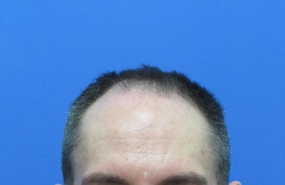 Male Hair Transplant Before & After Gallery - Patient 302922 - Image 1
