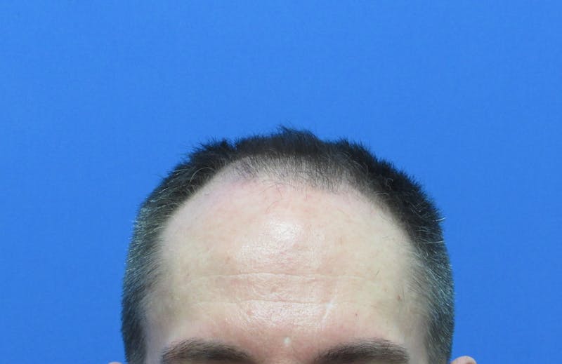 Male Hair Transplant Before & After Gallery - Patient 302922 - Image 1