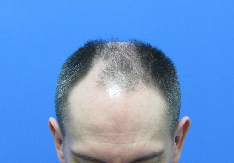 Male Hair Transplant Before & After Gallery - Patient 302922 - Image 3