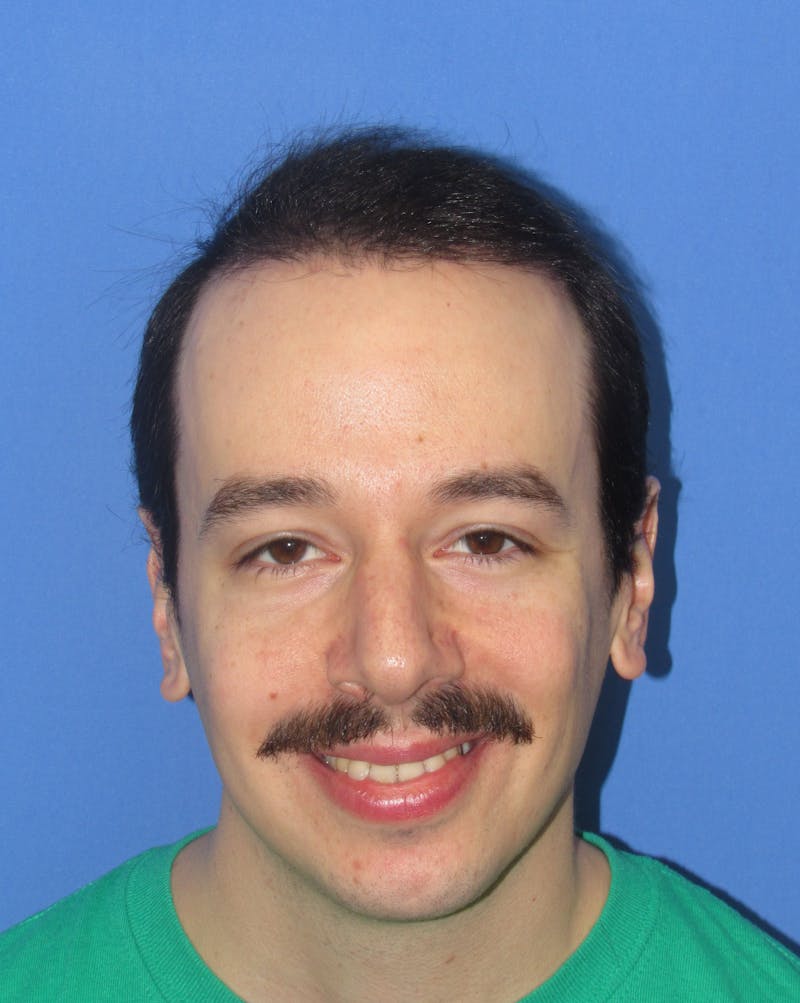 Male Hair Transplant Before & After Gallery - Patient 229341 - Image 2