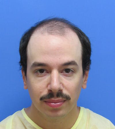 Male Hair Transplant Before & After Gallery - Patient 229341 - Image 1