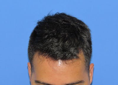 Male Hair Transplant Before & After Gallery - Patient 201491 - Image 2