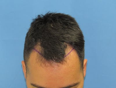 Male Hair Transplant Before & After Gallery - Patient 201491 - Image 1