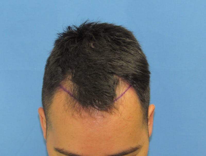 Male Hair Transplant Before & After Gallery - Patient 201491 - Image 1