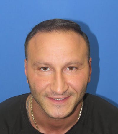 Male Hair Transplant Before & After Gallery - Patient 205390 - Image 2