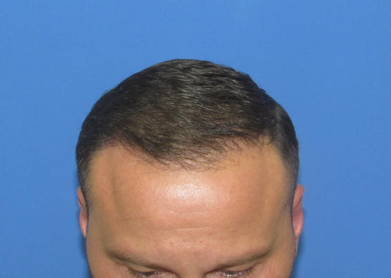 Male Hair Transplant Before & After Gallery - Patient 205390 - Image 4