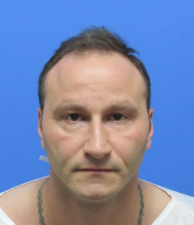 Male Hair Transplant Before & After Gallery - Patient 205390 - Image 1