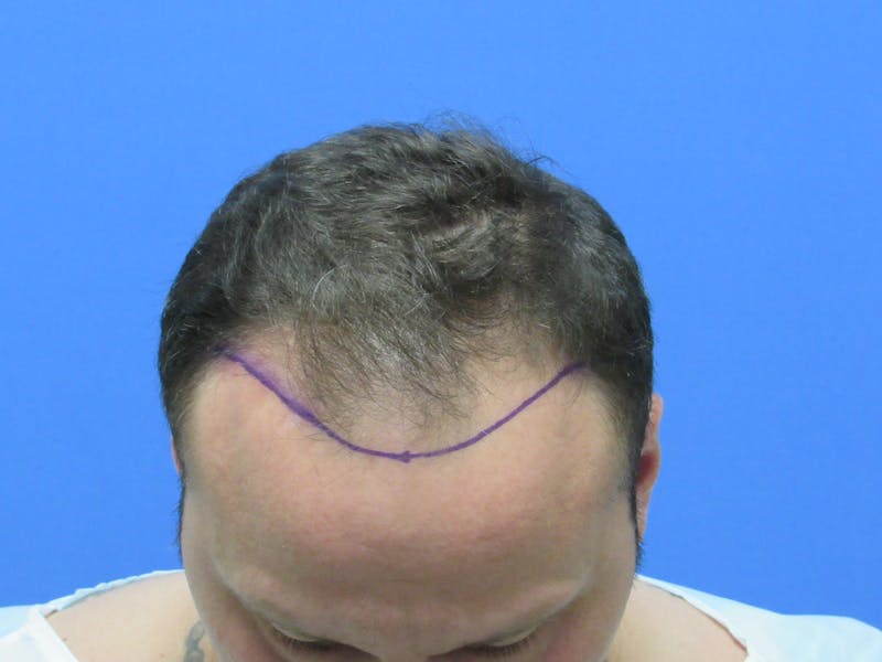 Male Hair Transplant Before & After Gallery - Patient 205390 - Image 3