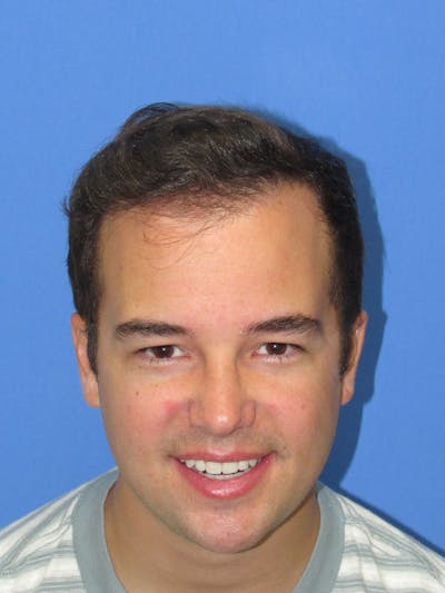 Male Hair Transplant Before & After Gallery - Patient 102886 - Image 2