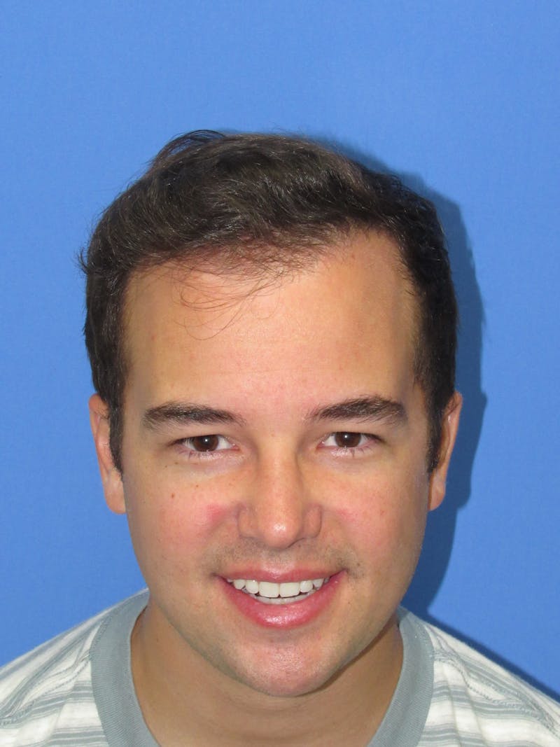 Male Hair Transplant Before & After Gallery - Patient 102886 - Image 2