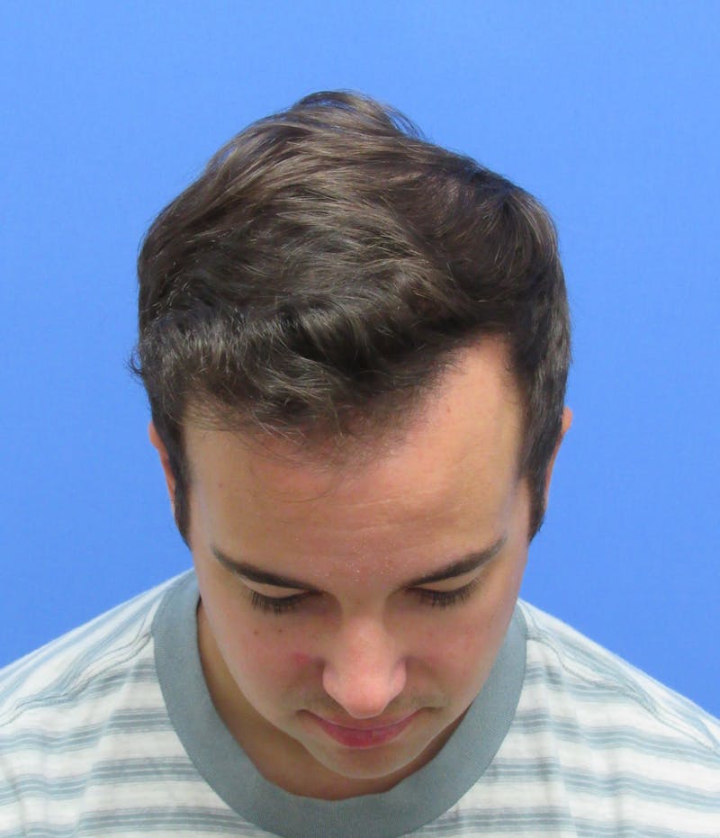 Male Hair Transplant Before & After Gallery - Patient 102886 - Image 4