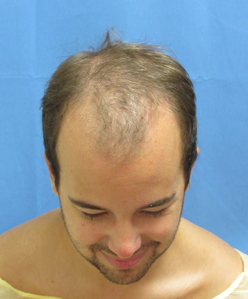 Male Hair Transplant Before & After Gallery - Patient 102886 - Image 3