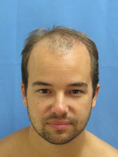 Male Hair Transplant Before & After Gallery - Patient 102886 - Image 1