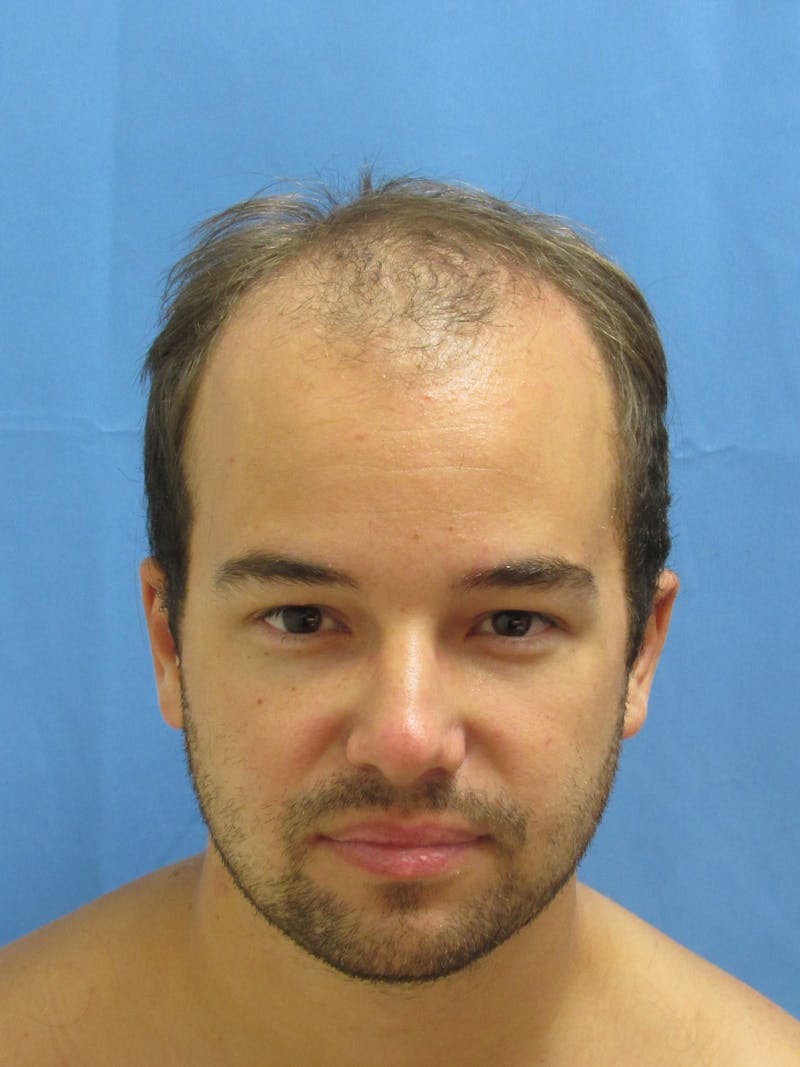 Male Hair Transplant Before & After Gallery - Patient 102886 - Image 1