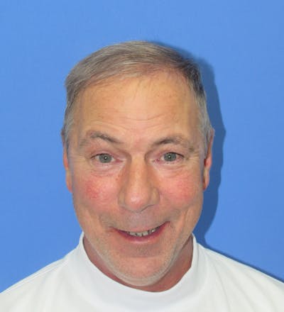 Male Hair Transplant Before & After Gallery - Patient 404718 - Image 2