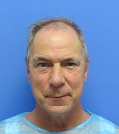 Male Hair Transplant Before & After Gallery - Patient 404718 - Image 1