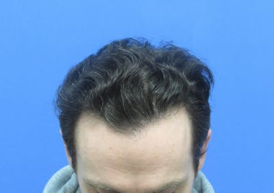 Male Hair Transplant Before & After Gallery - Patient 103206 - Image 2