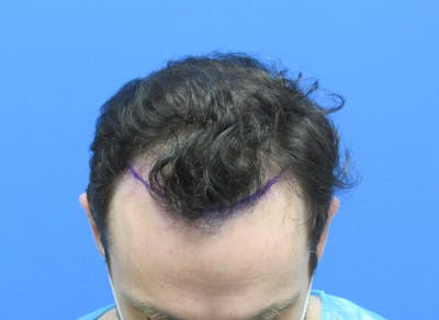 Male Hair Transplant Before & After Gallery - Patient 103206 - Image 1